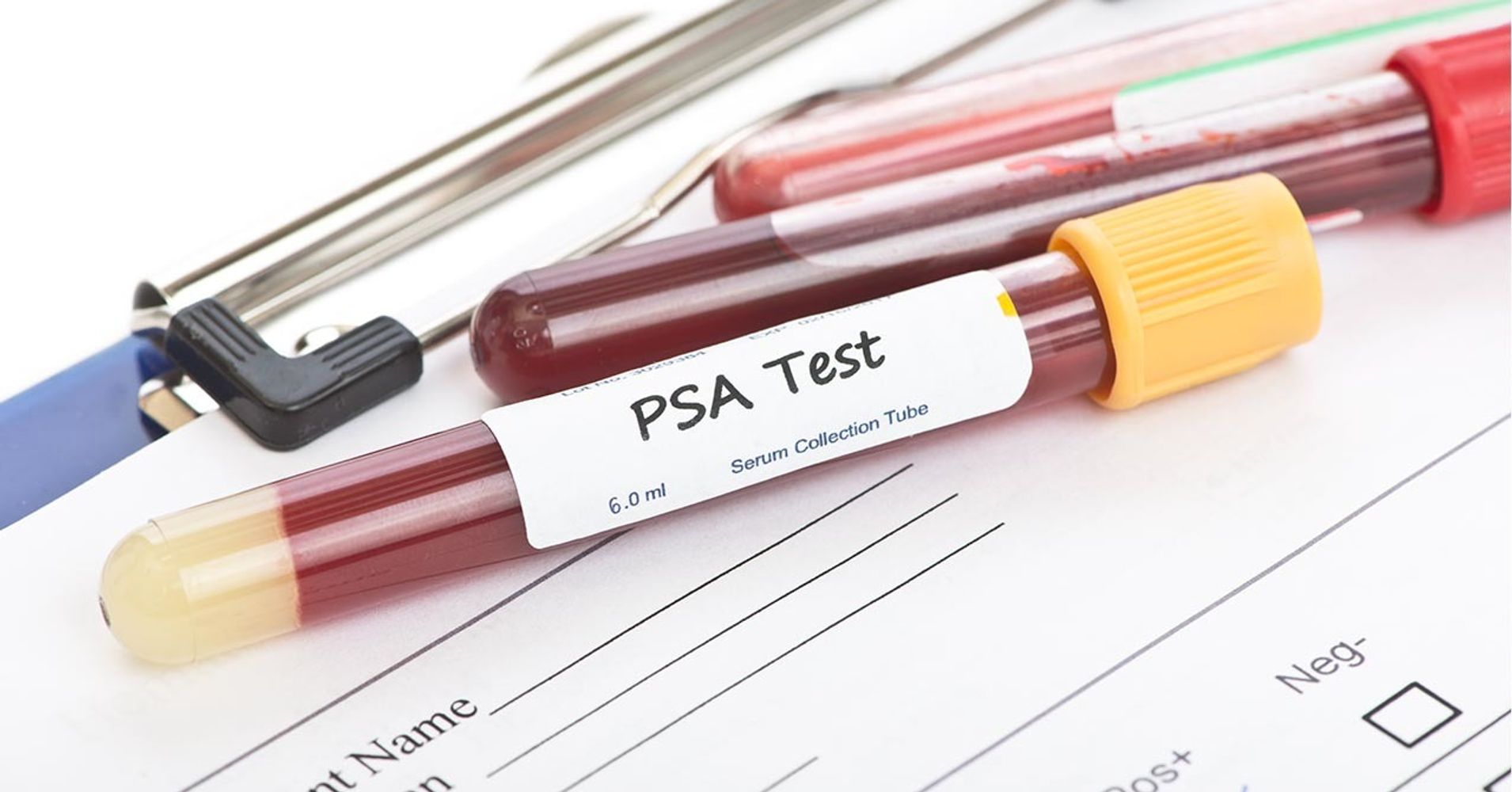 Testul PSA: Ce este și cum se efectuează