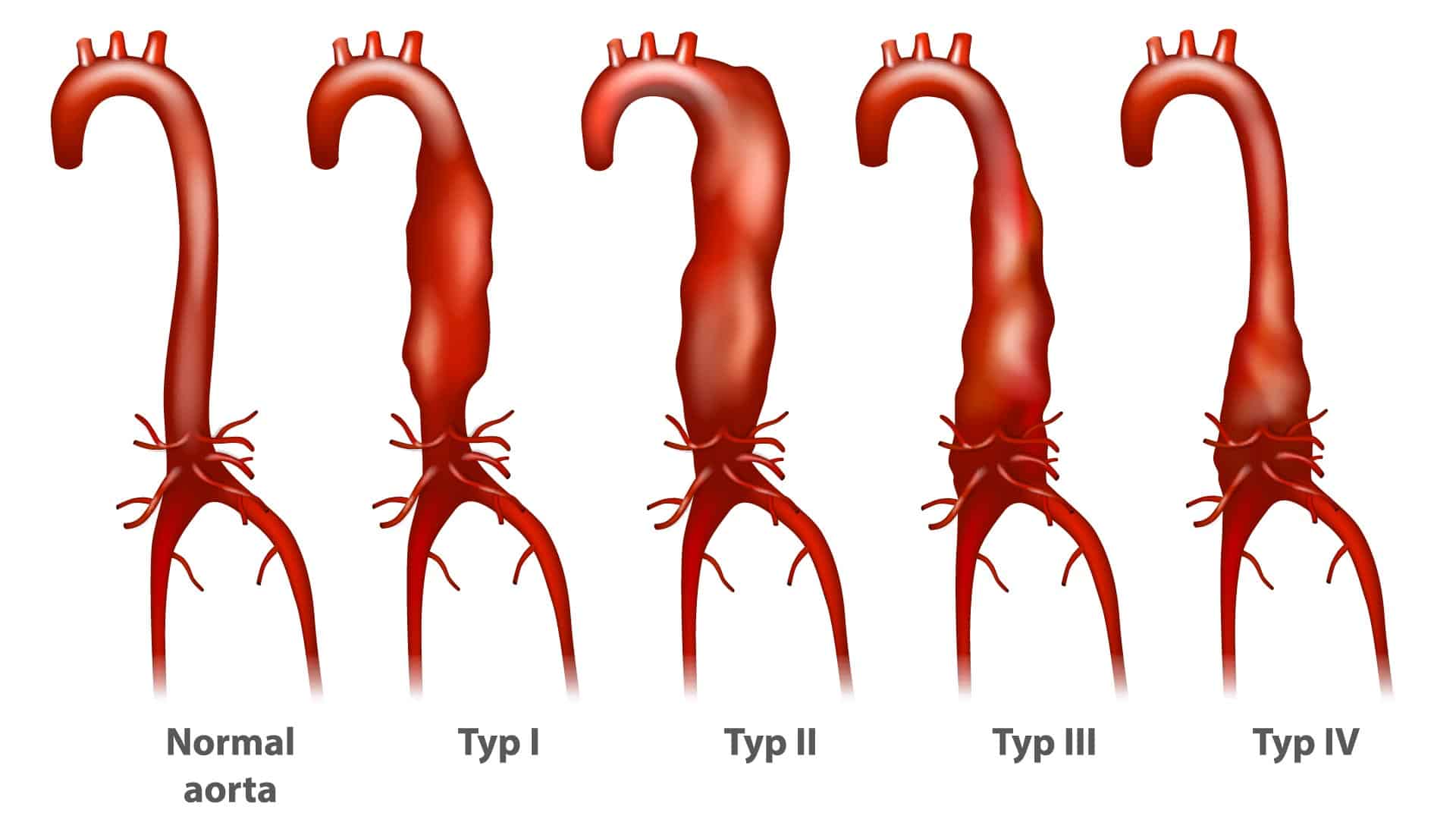 Boala aortică: simptome, cauze și tratament